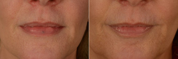 Cutera Excel V Laser Before and After Photos in Naples, FL, Patient 19386