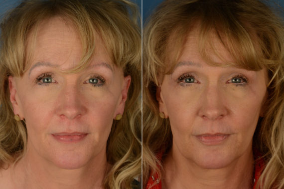 Cutera Excel V Laser Before and After Photos in Naples, FL, Patient 19386