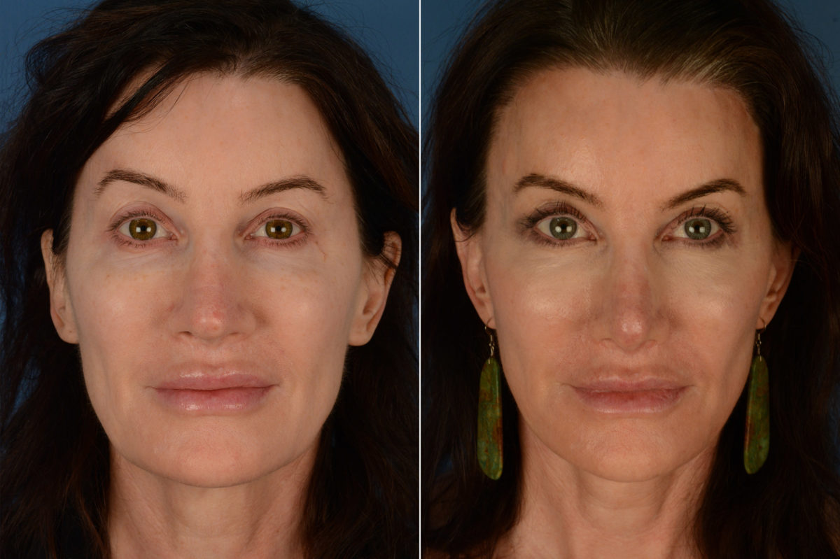 Revision Rhinoplasty Before and After Photos in Naples, FL, Patient 19408