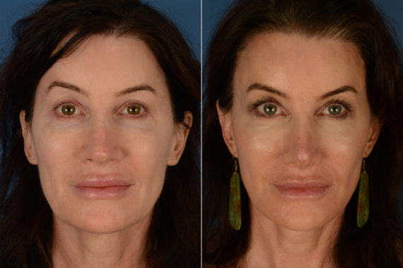Revision Rhinoplasty Before and After Photos in Naples, FL, Patient 19408