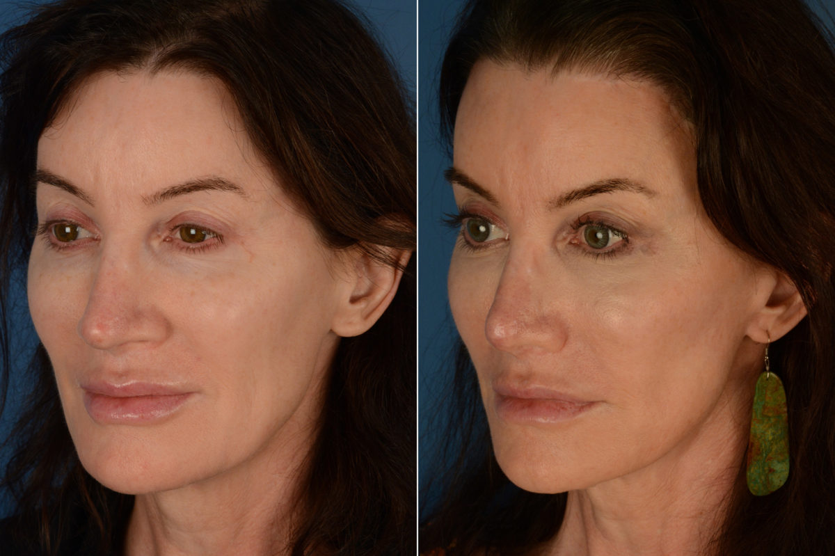 Revision Rhinoplasty Before and After Photos in Naples, FL, Patient 19408
