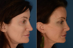Revision Rhinoplasty Before and After Photos in Naples, FL, Patient 19408