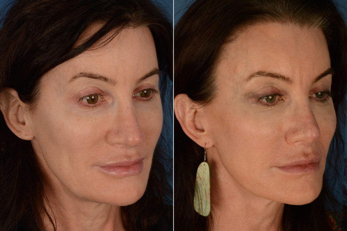 Revision Rhinoplasty Before and After Photos in Naples, FL, Patient 19408