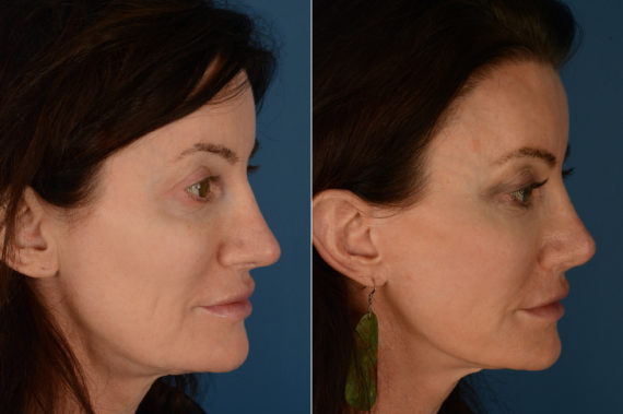 Revision Rhinoplasty Before and After Photos in Naples, FL, Patient 19408