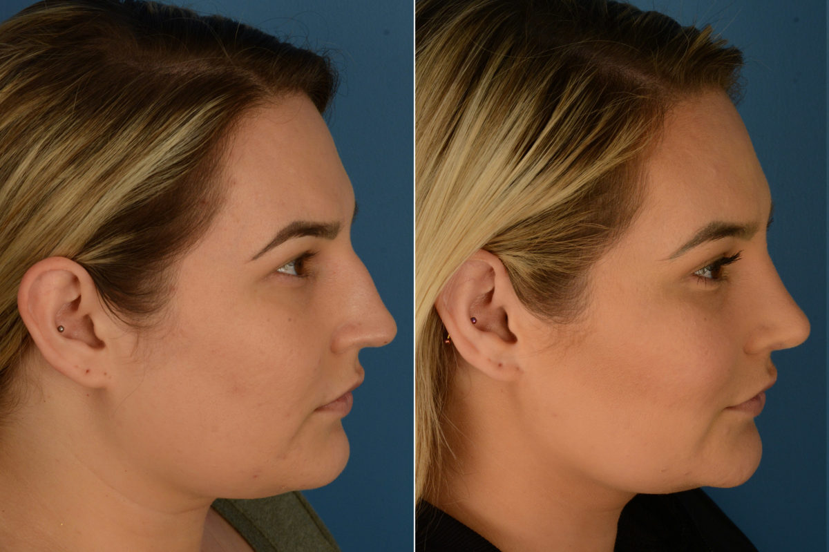 Rhinoplasty Before and After Photos in Naples, FL, Patient 19468
