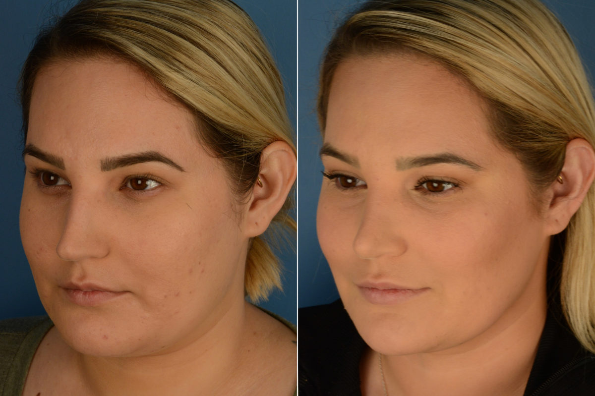 Rhinoplasty Before and After Photos in Naples, FL, Patient 19468