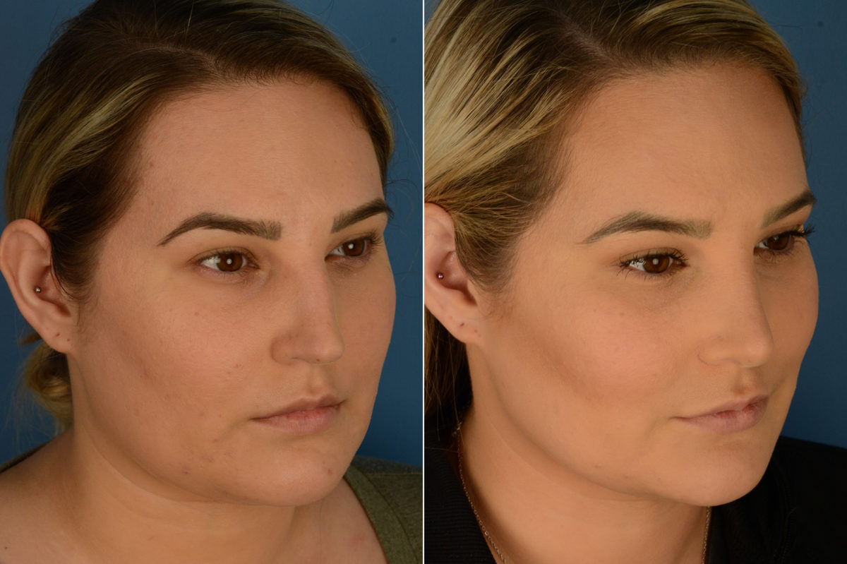 Rhinoplasty Before and After Photos in Naples, FL, Patient 19468