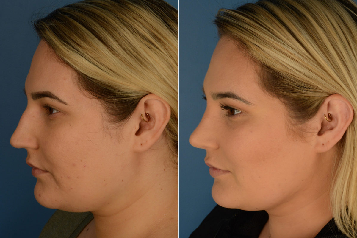 Rhinoplasty Before and After Photos in Naples, FL, Patient 19468