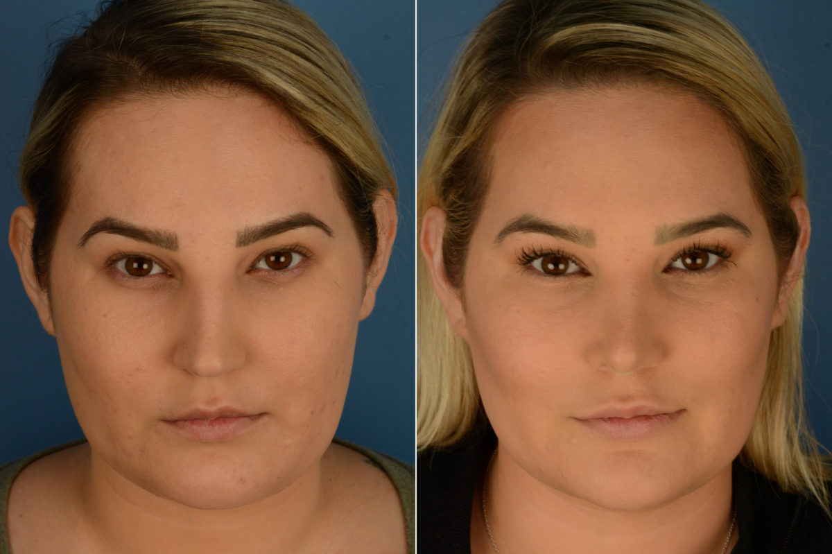 Rhinoplasty Before and After Photos in Naples, FL, Patient 19468