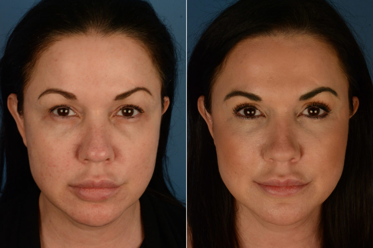 Blepharoplasty Before and After Photos in Naples, FL, Patient 19474
