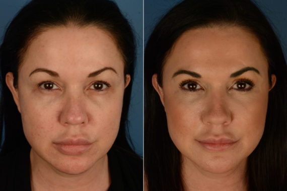 Blepharoplasty Before and After Photos in Naples, FL, Patient 19474