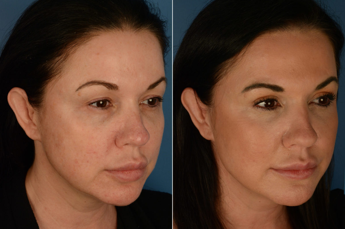 Blepharoplasty Before and After Photos in Naples, FL, Patient 19474