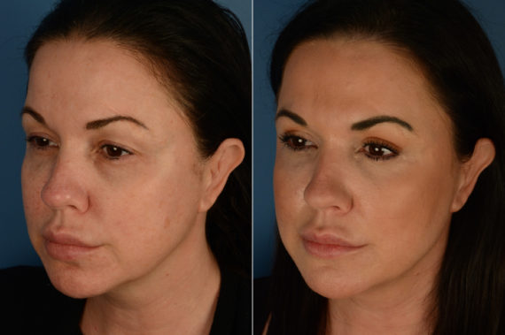 Blepharoplasty Before and After Photos in Naples, FL, Patient 19474