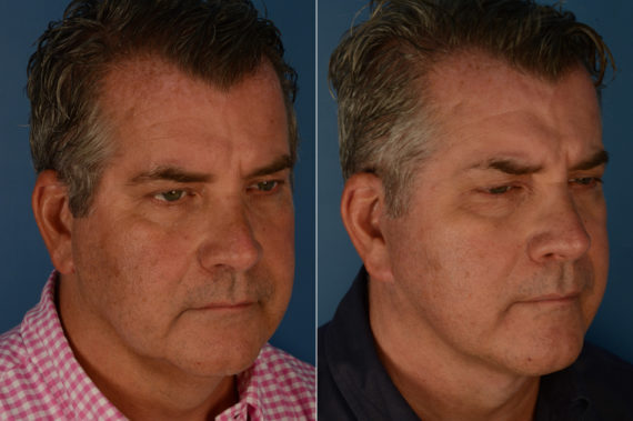 The UpLift™ Lower Face and Neck Lift Before and After Photos in Naples, FL, Patient 19521