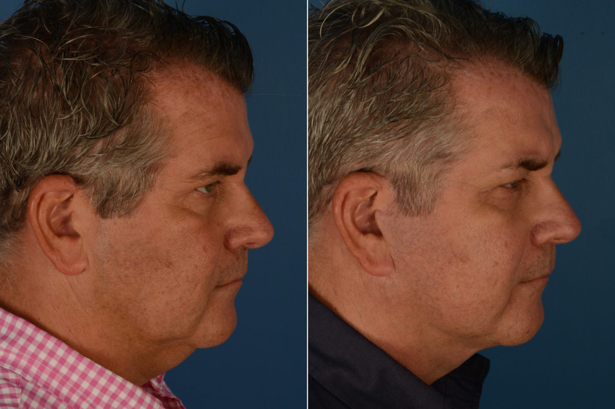 The UpLift™ Lower Face and Neck Lift Before and After Photos in Naples, FL, Patient 19521