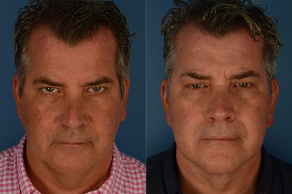 The UpLift™ Lower Face and Neck Lift Before and After Photos in Naples, FL, Patient 19521