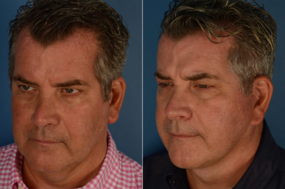 The UpLift™ Lower Face and Neck Lift Before and After Photos in Naples, FL, Patient 19521