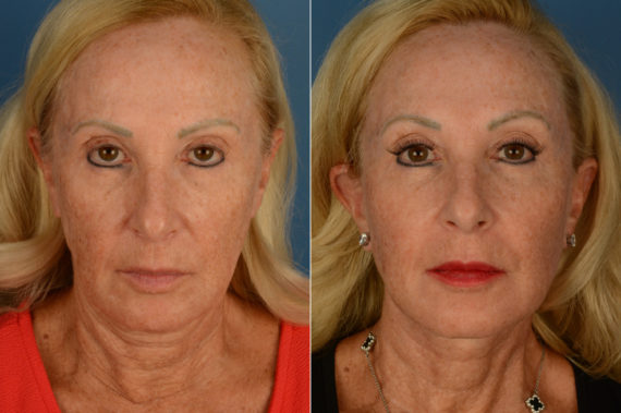 The UpLift™ Lower Face and Neck Lift Before and After Photos in Naples, FL, Patient 19731