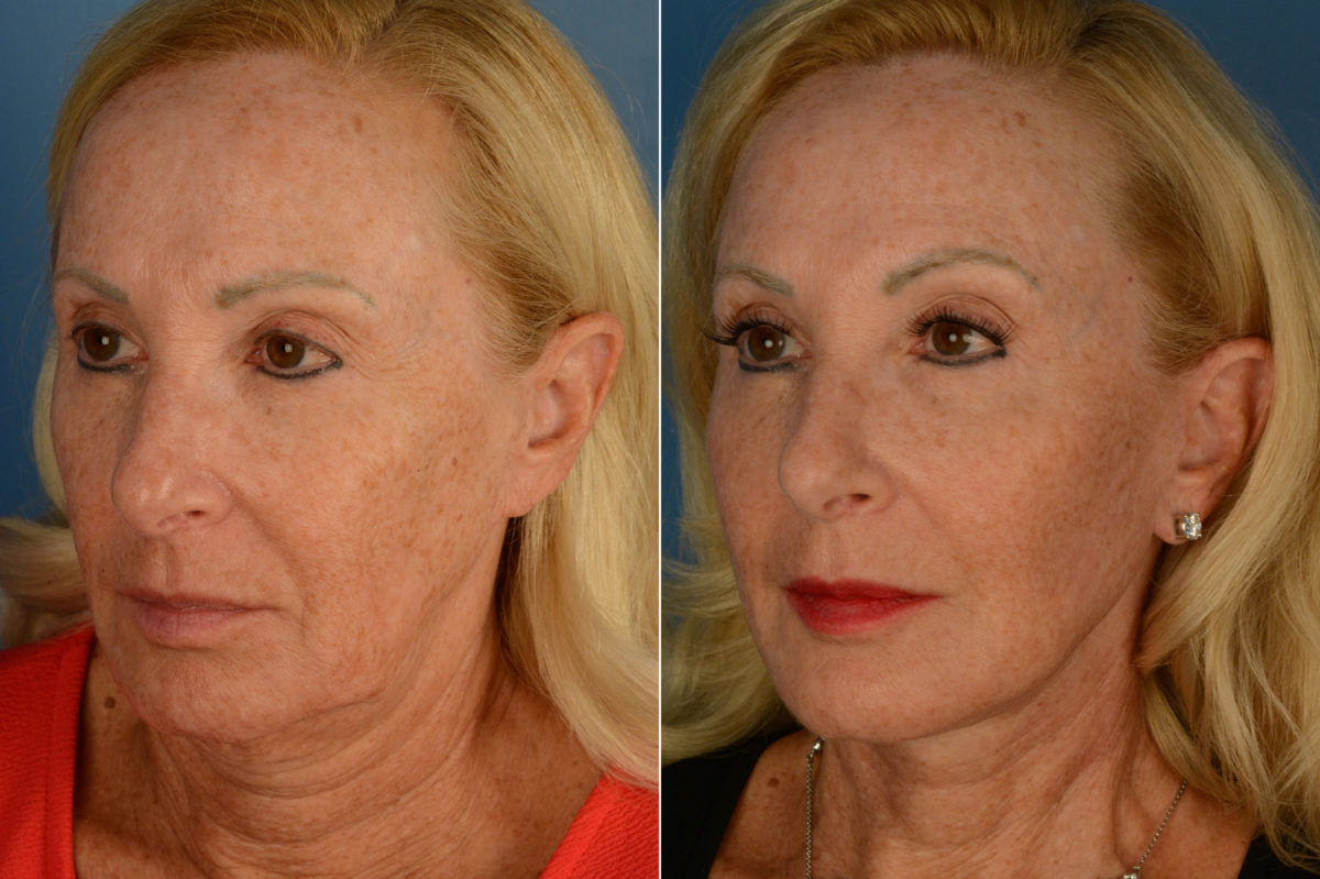 The UpLift™ Lower Face and Neck Lift Before and After Photos in Naples, FL, Patient 19731