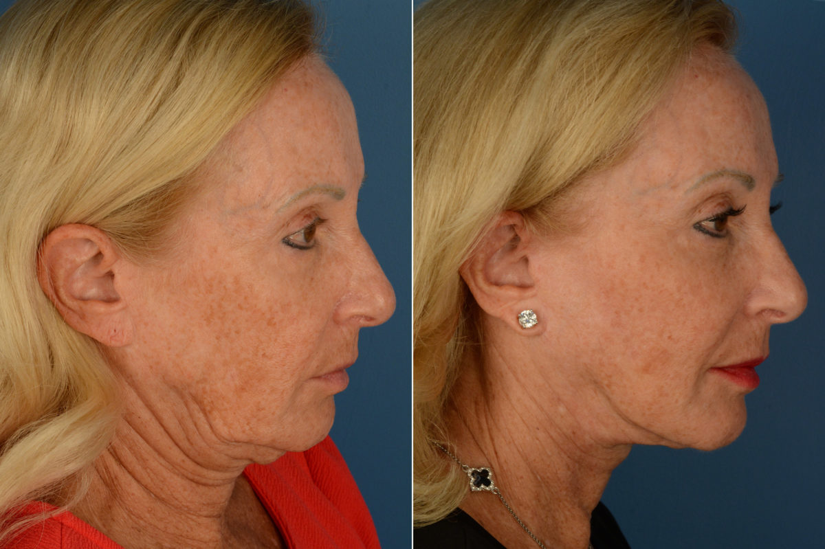 The UpLift™ Lower Face and Neck Lift Before and After Photos in Naples, FL, Patient 19731