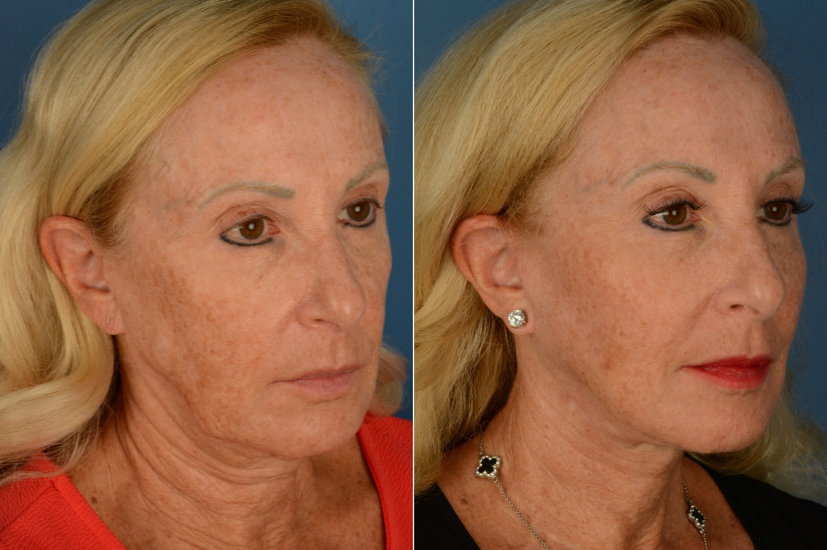 The UpLift™ Lower Face and Neck Lift Before and After Photos in Naples, FL, Patient 19731