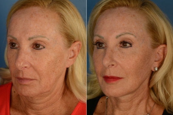 The UpLift™ Lower Face and Neck Lift Before and After Photos in Naples, FL, Patient 19731