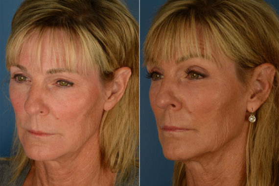 Fat Transfer Before and After Photos in Naples, FL, Patient 19978