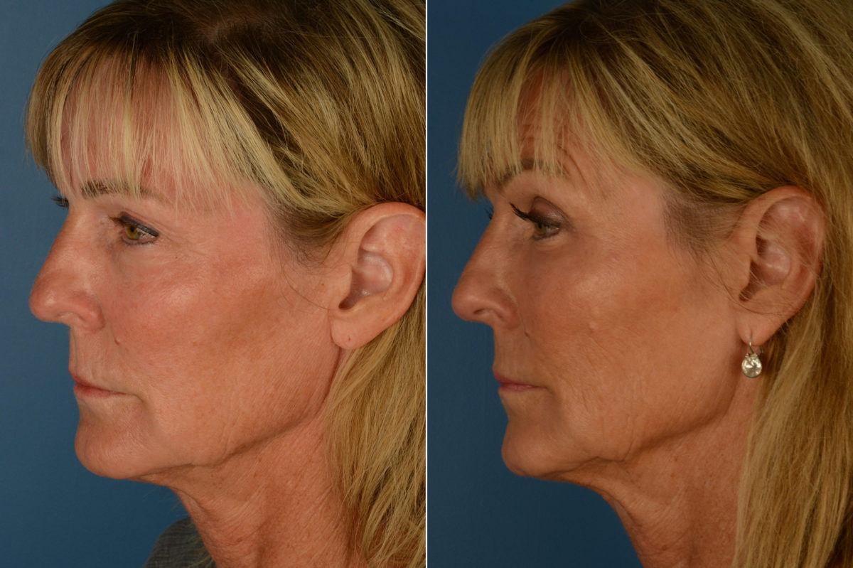 Fat Transfer Before and After Photos in Naples, FL, Patient 19978