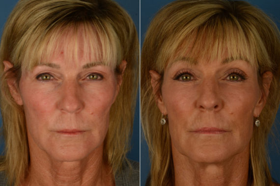 Fat Transfer Before and After Photos in Naples, FL, Patient 19978