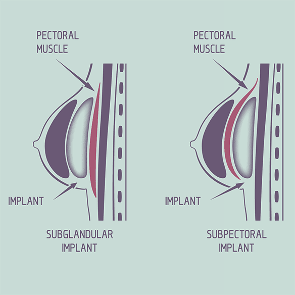 3 Reasons Why Natural Boobs Trump Implants