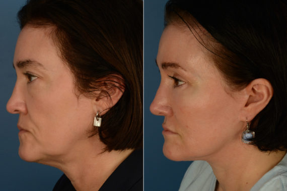 The UpLift™ Lower Face and Neck Lift Before and After Photos in Naples, FL, Patient 20067