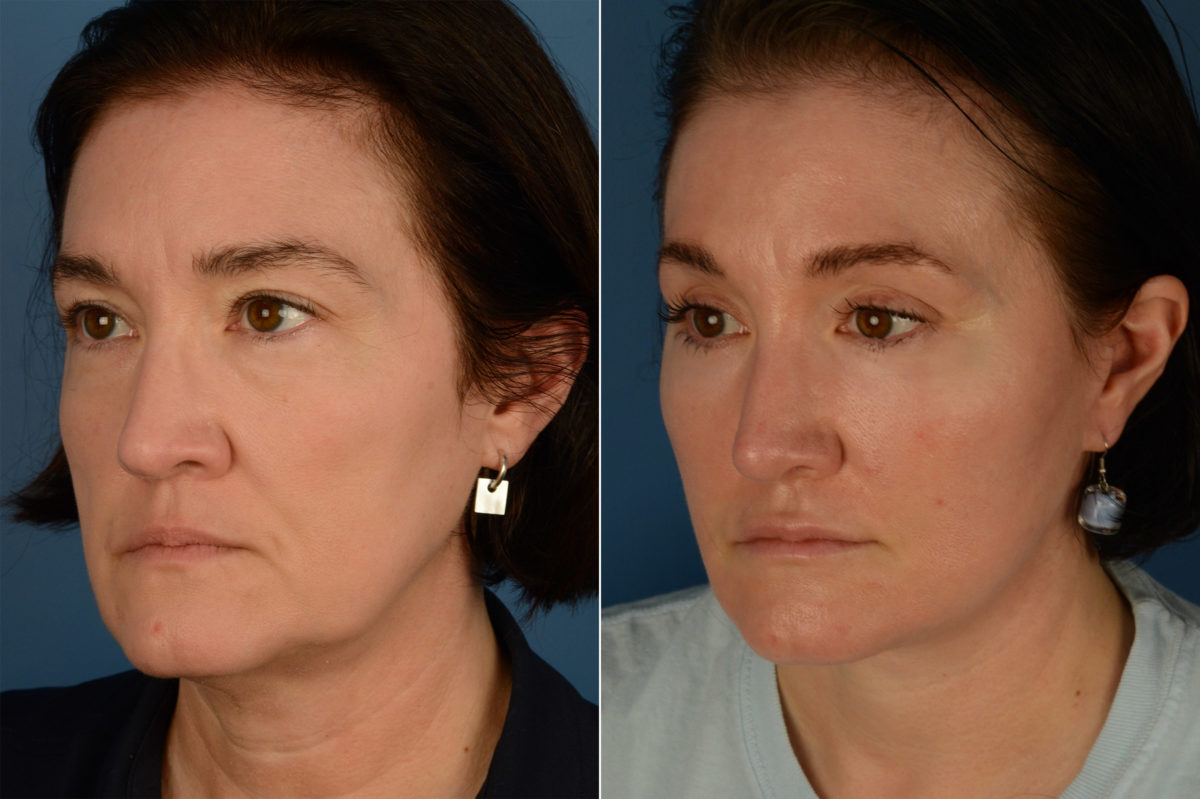 Fat Transfer Before and After Photos in Naples, FL, Patient 20067