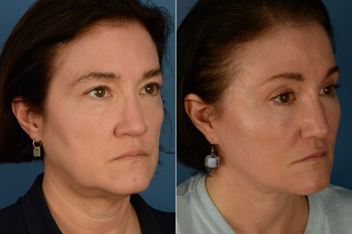 Fat Transfer Before and After Photos in Naples, FL, Patient 20067
