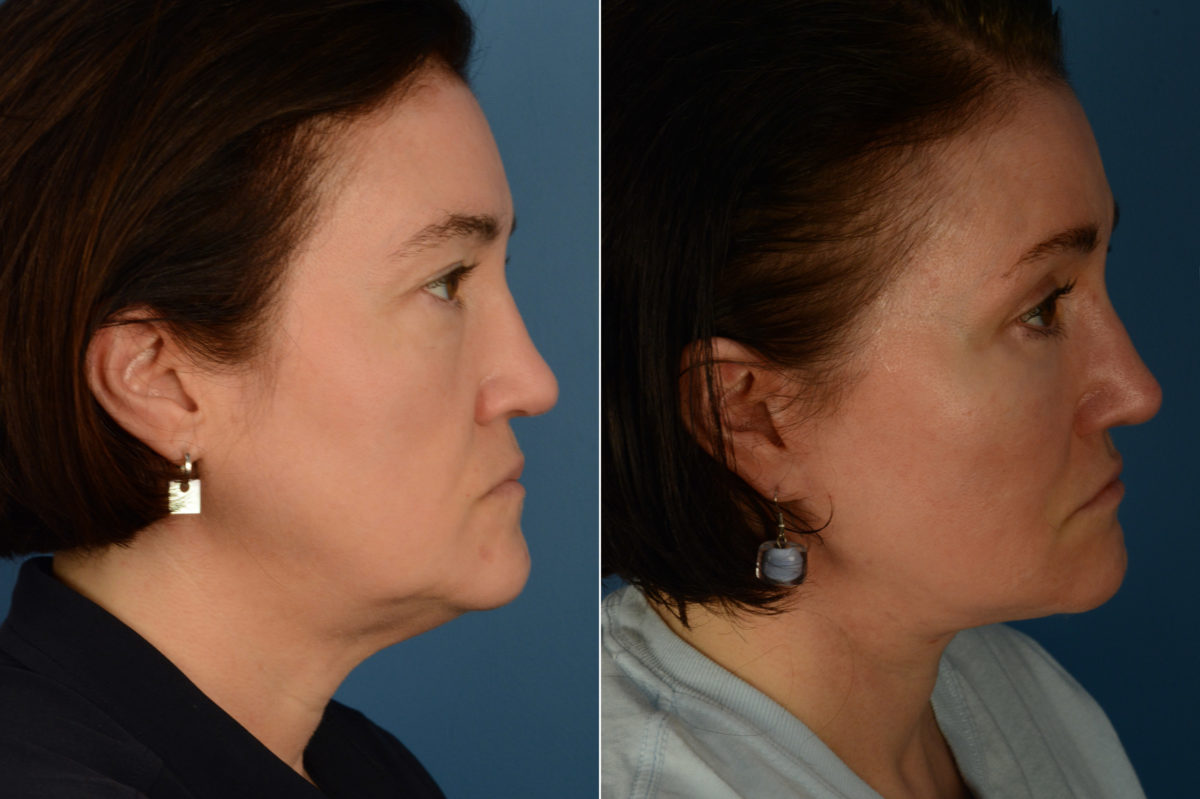 Fat Transfer Before and After Photos in Naples, FL, Patient 20067
