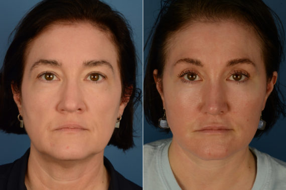 The UpLift™ Lower Face and Neck Lift Before and After Photos in Naples, FL, Patient 20067