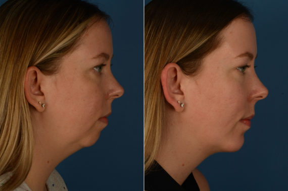 Chin Implant Before and After Photos in Naples, FL, Patient 20170