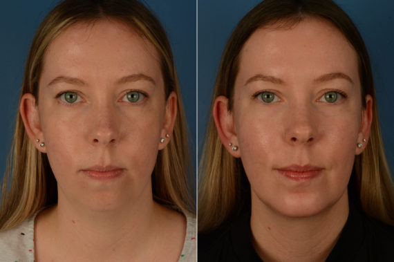 Chin Implant Before and After Photos in Naples, FL, Patient 20170