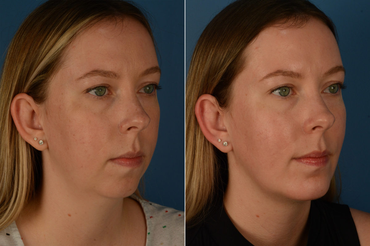 Chin Implant Before and After Photos in Naples, FL, Patient 20170