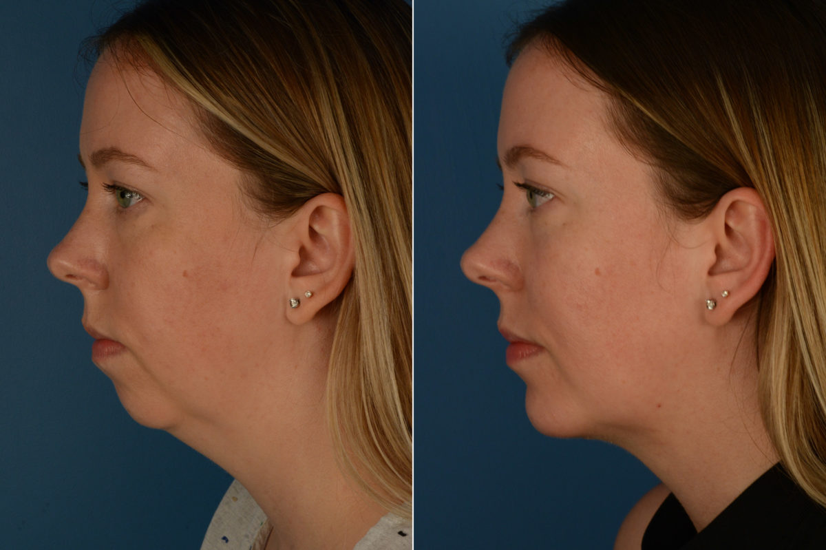 Chin Implant Before and After Photos in Naples, FL, Patient 20170