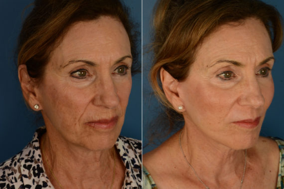 Cheek Implants Before and After Photos in Naples, FL, Patient 20291