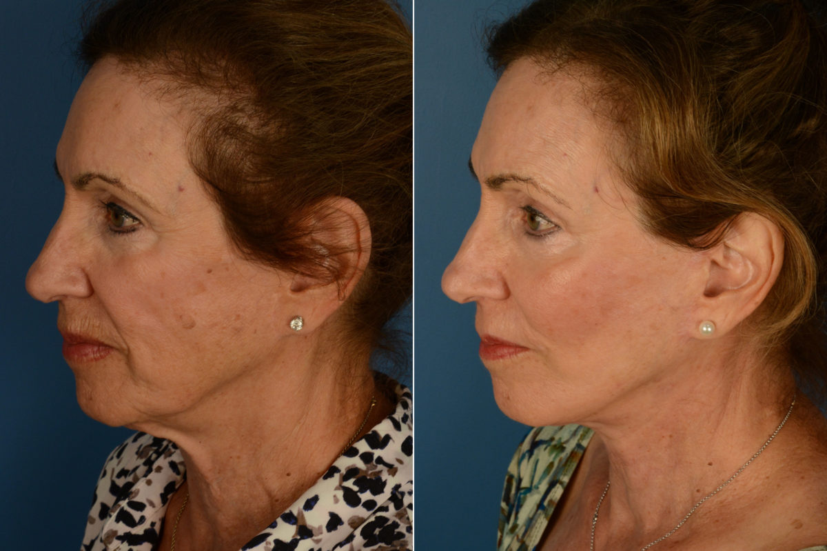 Cheek Implants Before and After Photos in Naples, FL, Patient 20291