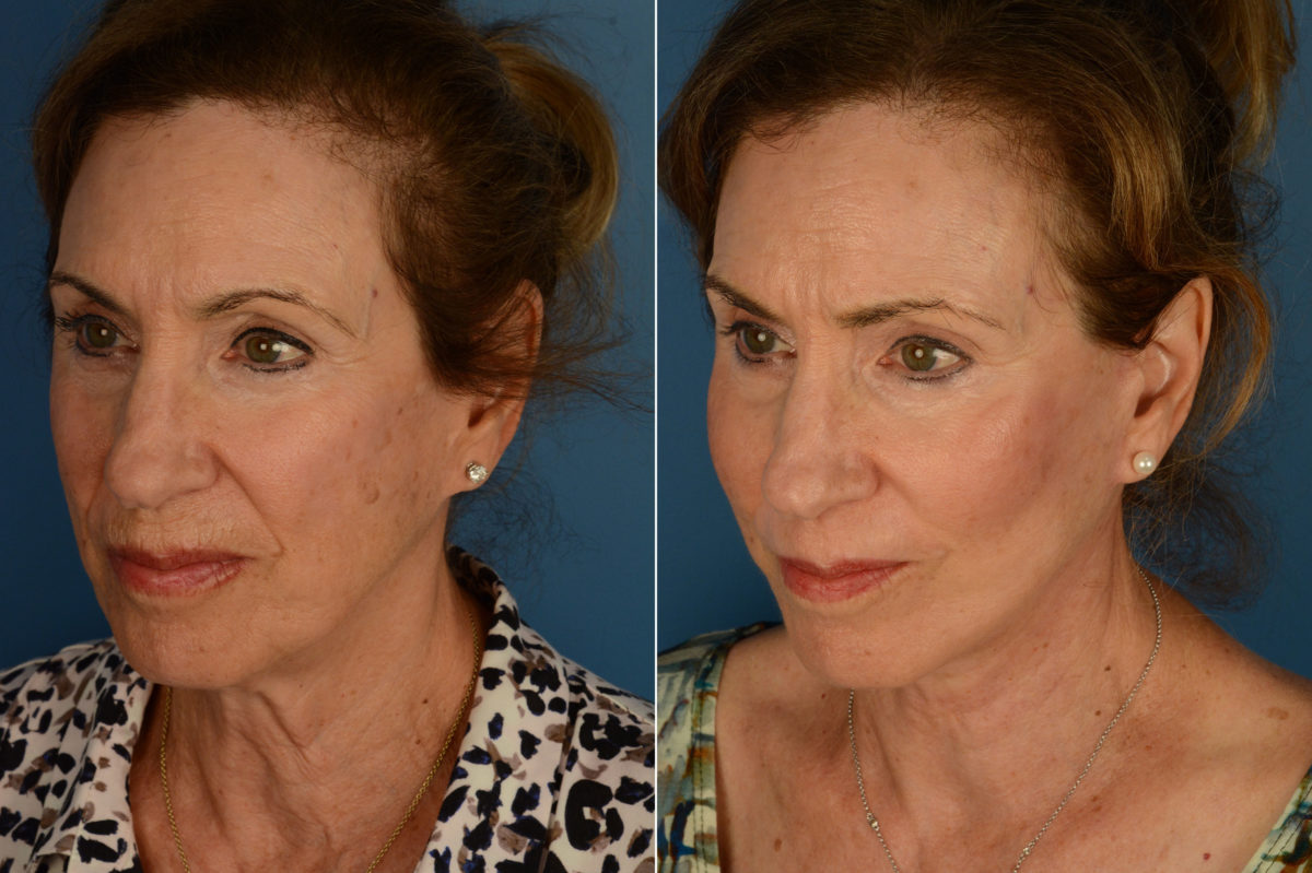 Cheek Implants Before and After Photos in Naples, FL, Patient 20291