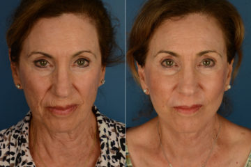Cheek Implants Before and After Photos in Naples, FL, Patient 20291