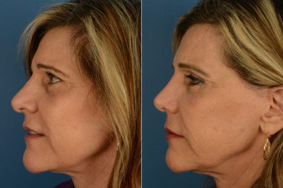 Revision Rhinoplasty Before and After Photos in Naples, FL, Patient 20304