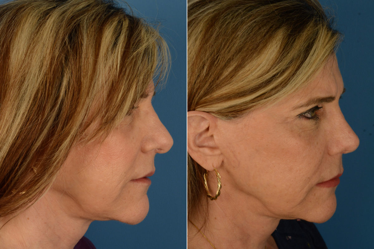 Revision Rhinoplasty Before and After Photos in Naples, FL, Patient 20304