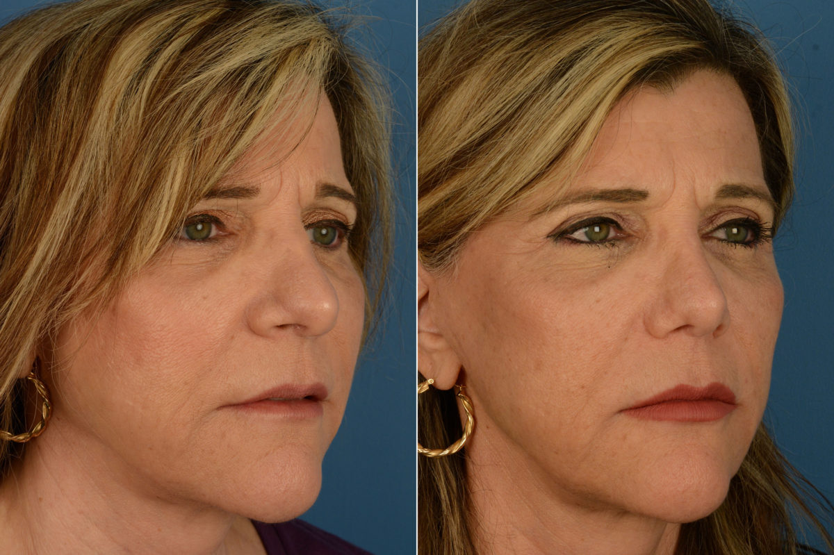 Revision Rhinoplasty Before and After Photos in Naples, FL, Patient 20304