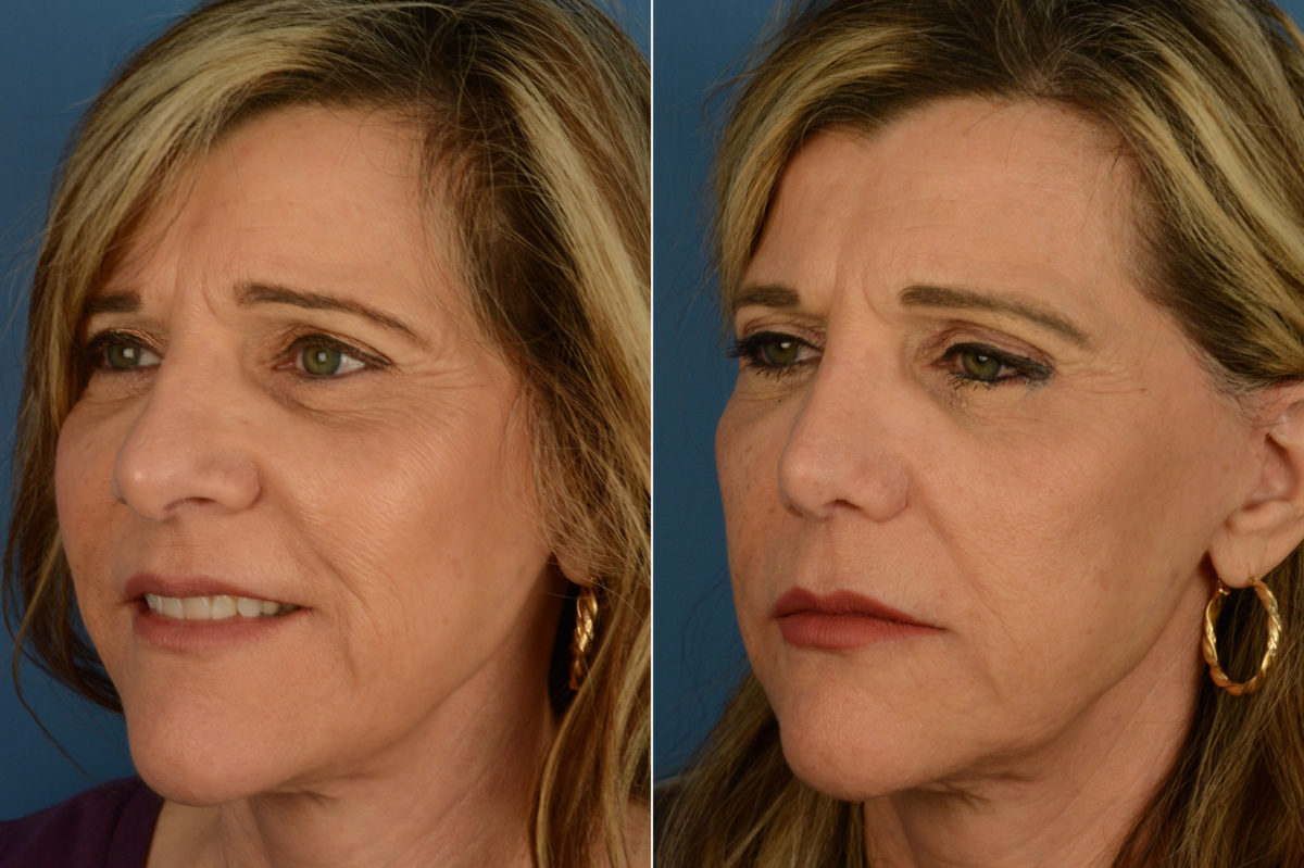 Revision Rhinoplasty Before and After Photos in Naples, FL, Patient 20304