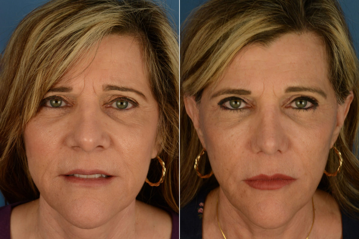 Revision Rhinoplasty Before and After Photos in Naples, FL, Patient 20304