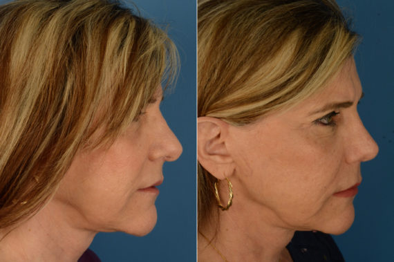 Revision Rhinoplasty Before and After Photos in Naples, FL, Patient 20304