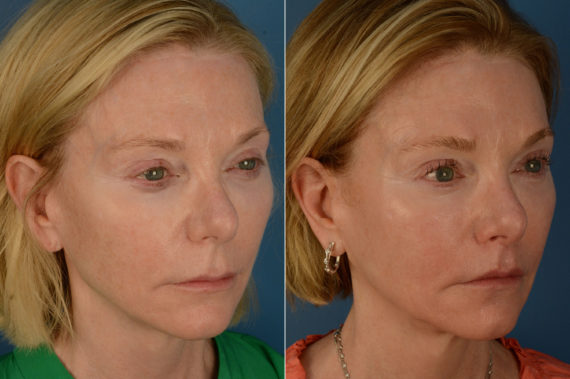 Lip Lift Before and After Photos in Naples, FL, Patient 20321